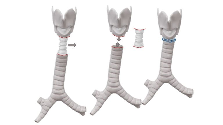 Tracheal Resection